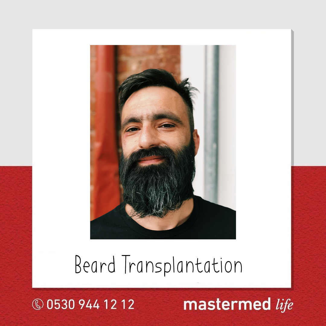 Beard Transplantation